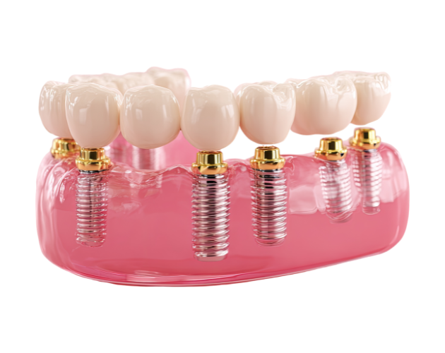 Expert Dental Implants in Bhopal