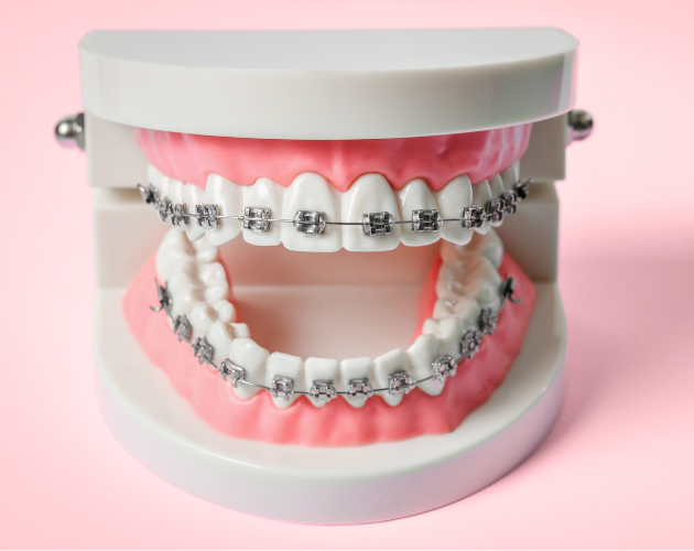Braces and Clear Invisible Aligners in Bhopal