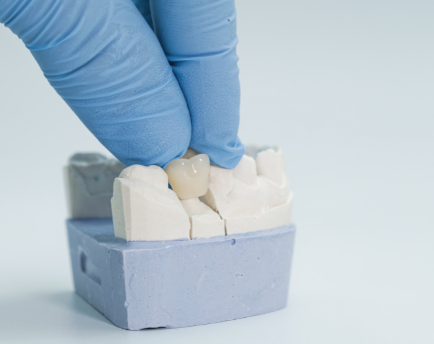 Custom Crowns, Bridges & Dentures in Bhopal