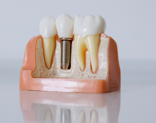 Advanced Dental Implants Bhopal