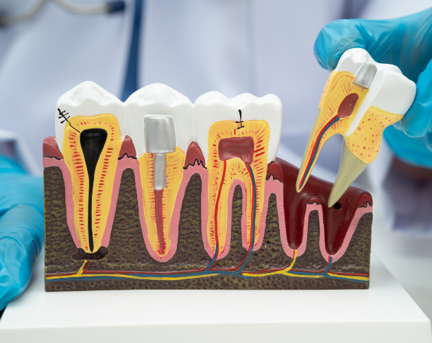 Painless Root Canal Treatment in Bhopal