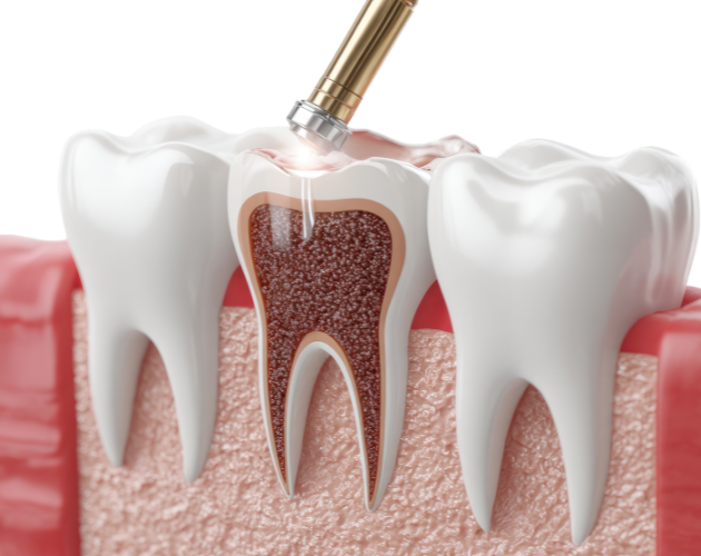 Composite Dental Fillings & Restoration at Bhopal Clinic