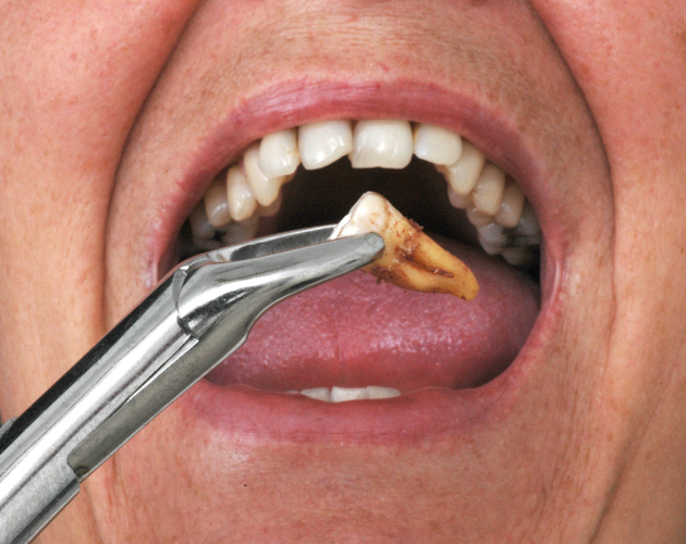 Safe Wisdom Tooth Removal Bhopal