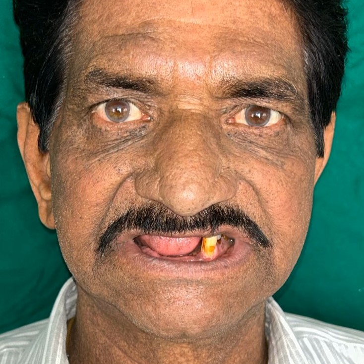 Before Implant Treatment