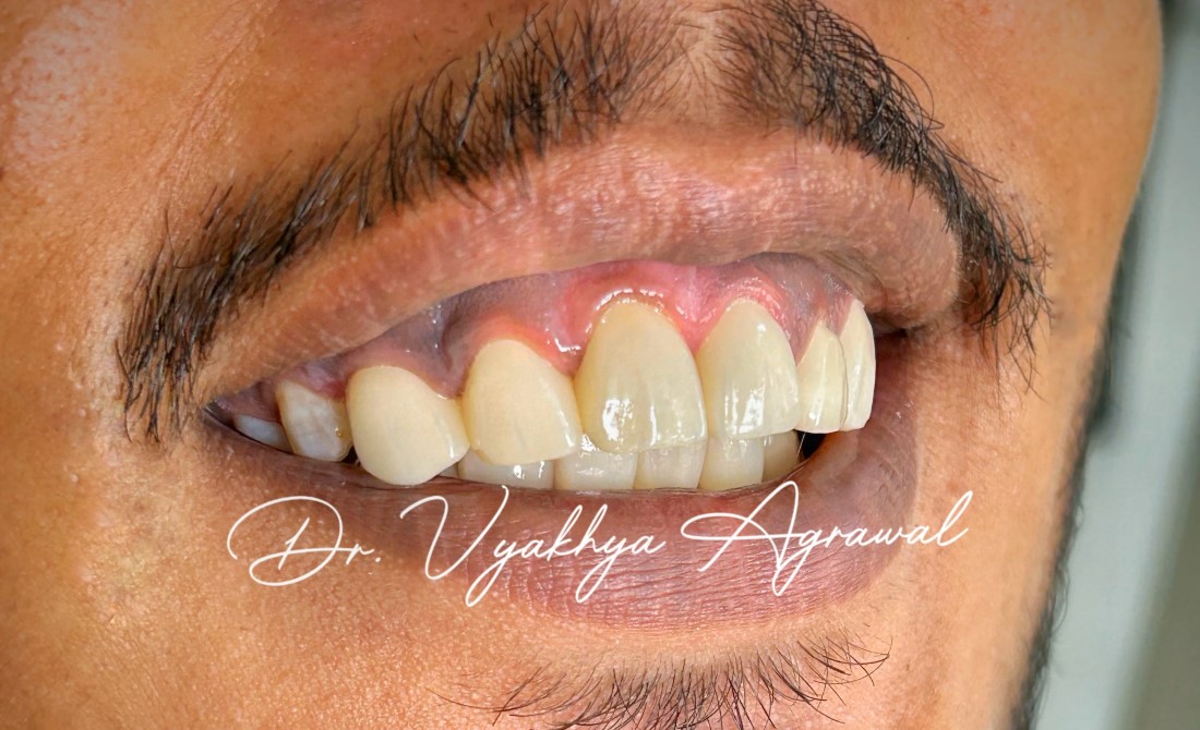 After Full Mouth Restoration