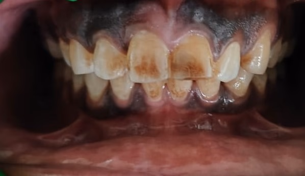 Before Full Mouth Restoration