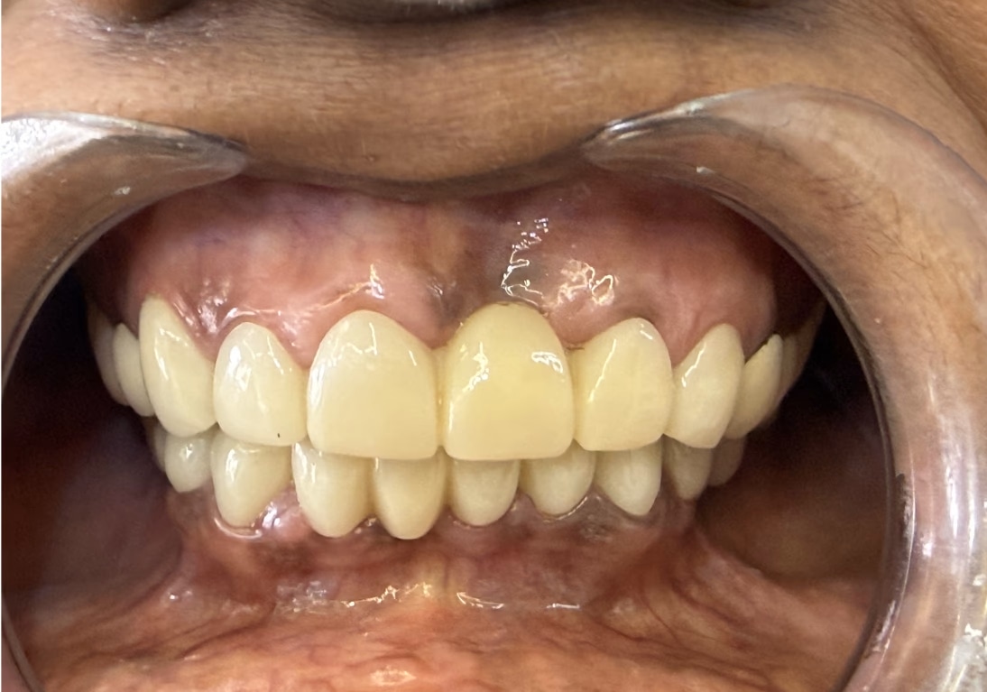 After Clear Aligner Treatment