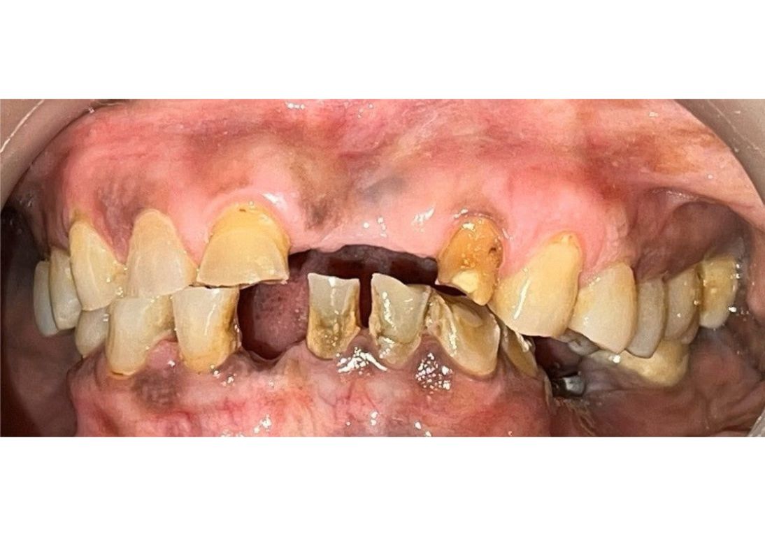 Before Clear Aligner Treatment